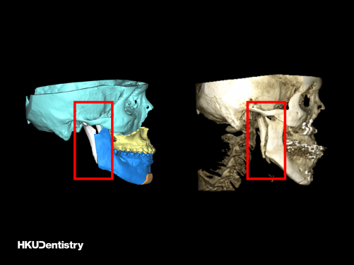 口內垂直支骨切開術: (左) 術前虛擬手術計劃（紅框）;（右）術後CT掃描（紅框）。